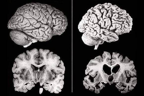 Alzheimerrari buruzko hitzaldia antolatu dute martitzenerako
