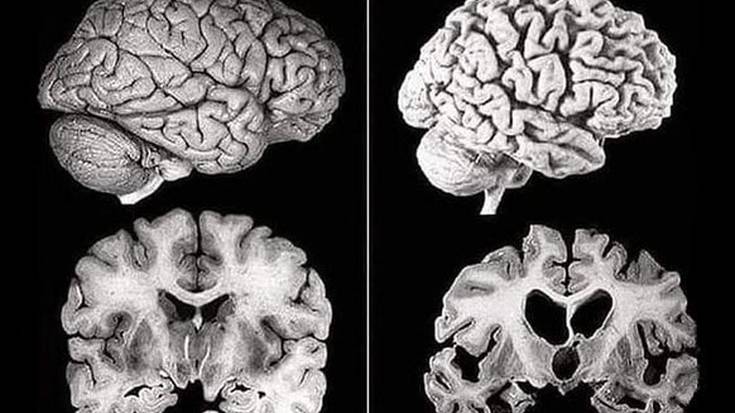 Alzheimerrari buruzko hitzaldia antolatu dute martitzenerako